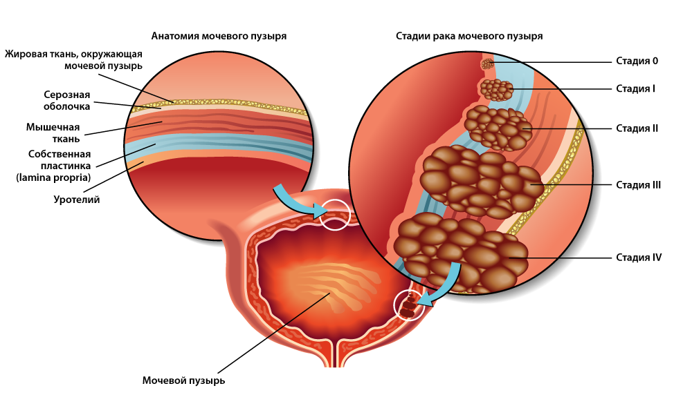 Рак мочевого пузыря клиническая картина